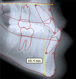 Interactive measurement (Me-NL distance).