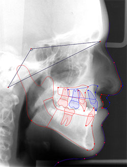 Tracing image (traced w. treatment plan)