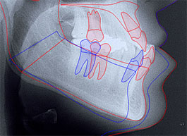 Planning, i.e. treatment simulation