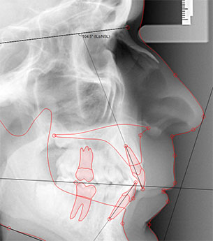 Cephalometric measurements and lines.